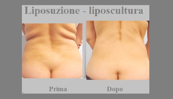 Come badare a un petto dopo aumento